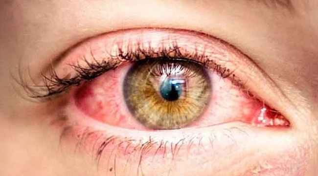 Uykusuzluk Göz Kapaklarını İçine Döndürdü